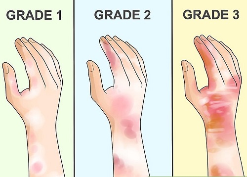 تصویری از سوختگی با اسید فلوئوریک 